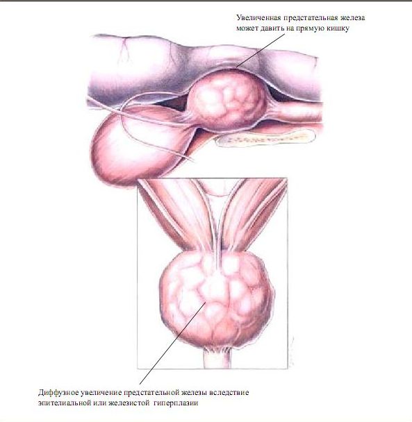 Простата форма. Патология предстательной железы. Увеличение предстательной железы. Форма предстательной железы.