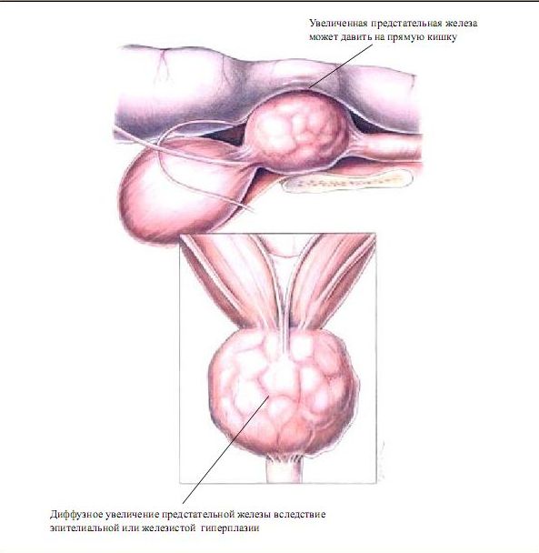 Поражение предстательной железы. Патология предстательной железы. Увеличение предстательной железы. Форма предстательной железы.